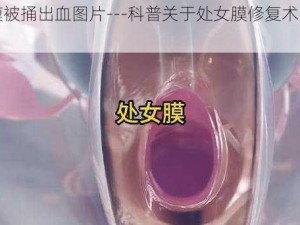 处钕膜被捅出血图片---科普关于处女膜修复术的相关知识