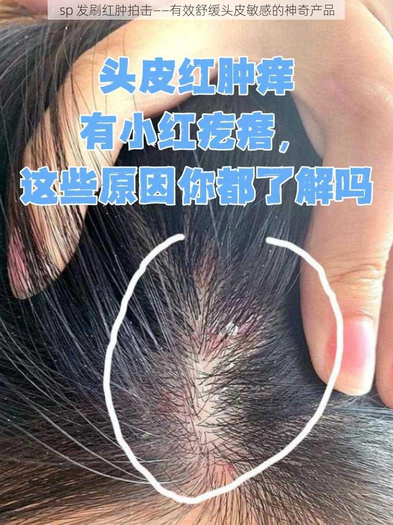 sp 发刷红肿拍击——有效舒缓头皮敏感的神奇产品